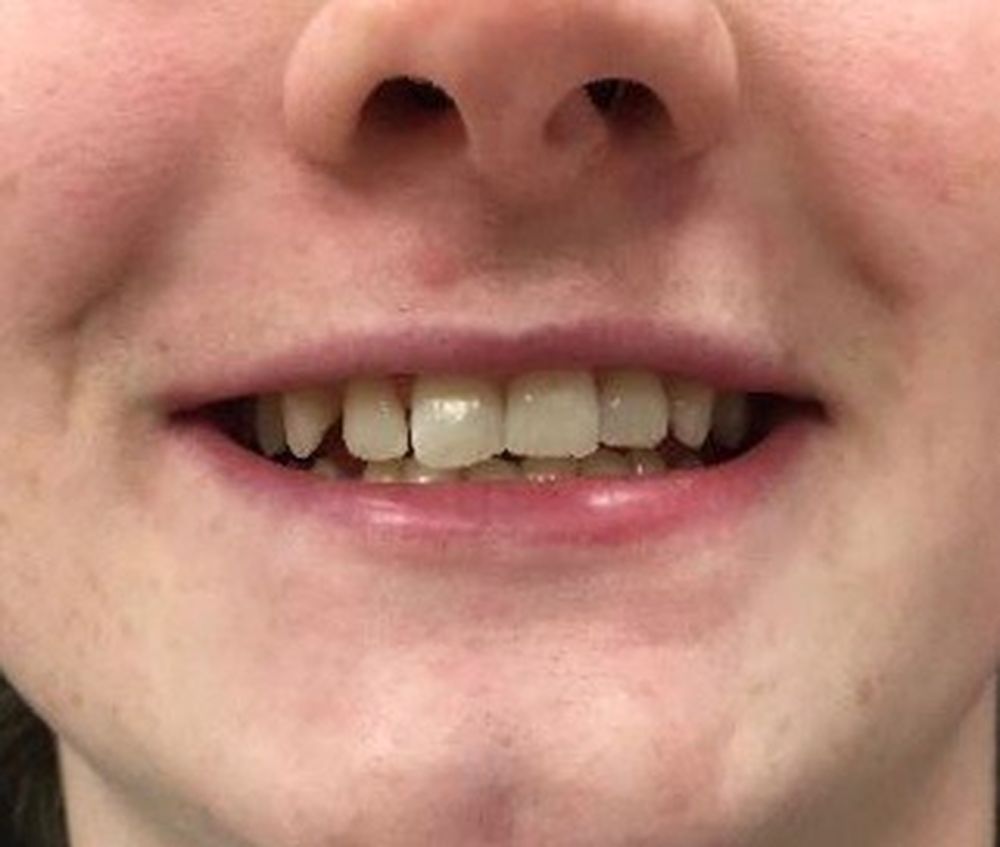 chantelle-6-month-braces-before